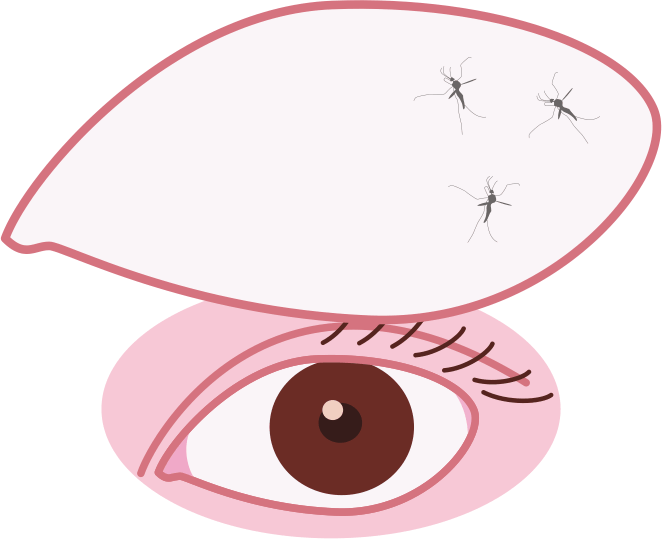 視界に小さな虫の影が浮かんで見える飛蚊症のイラスト