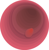 大腸内視鏡で発見された大腸ポリープのイラスト